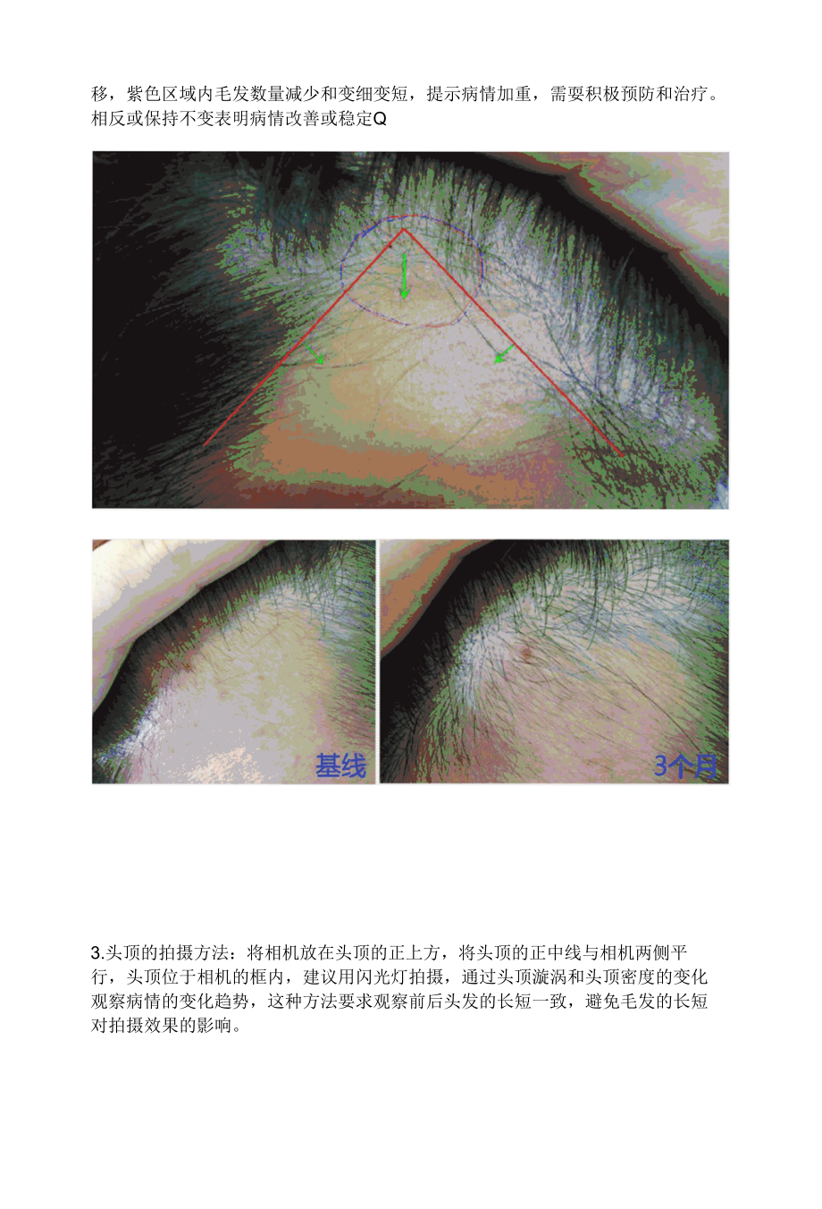 脱发患者自我管理方法.docx_第2页