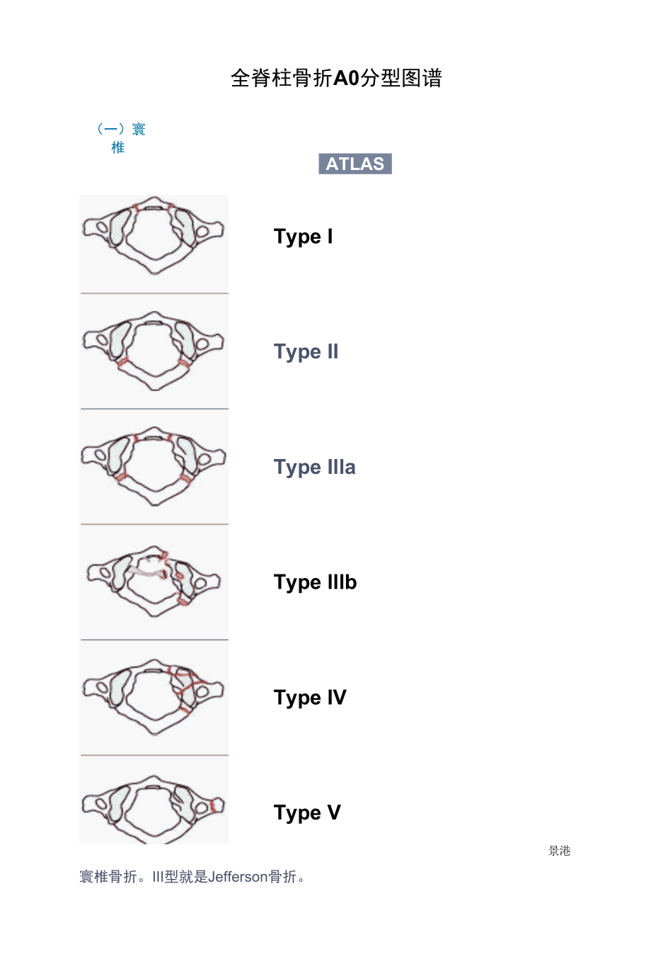 全脊柱骨折AO分型图谱.docx_第1页
