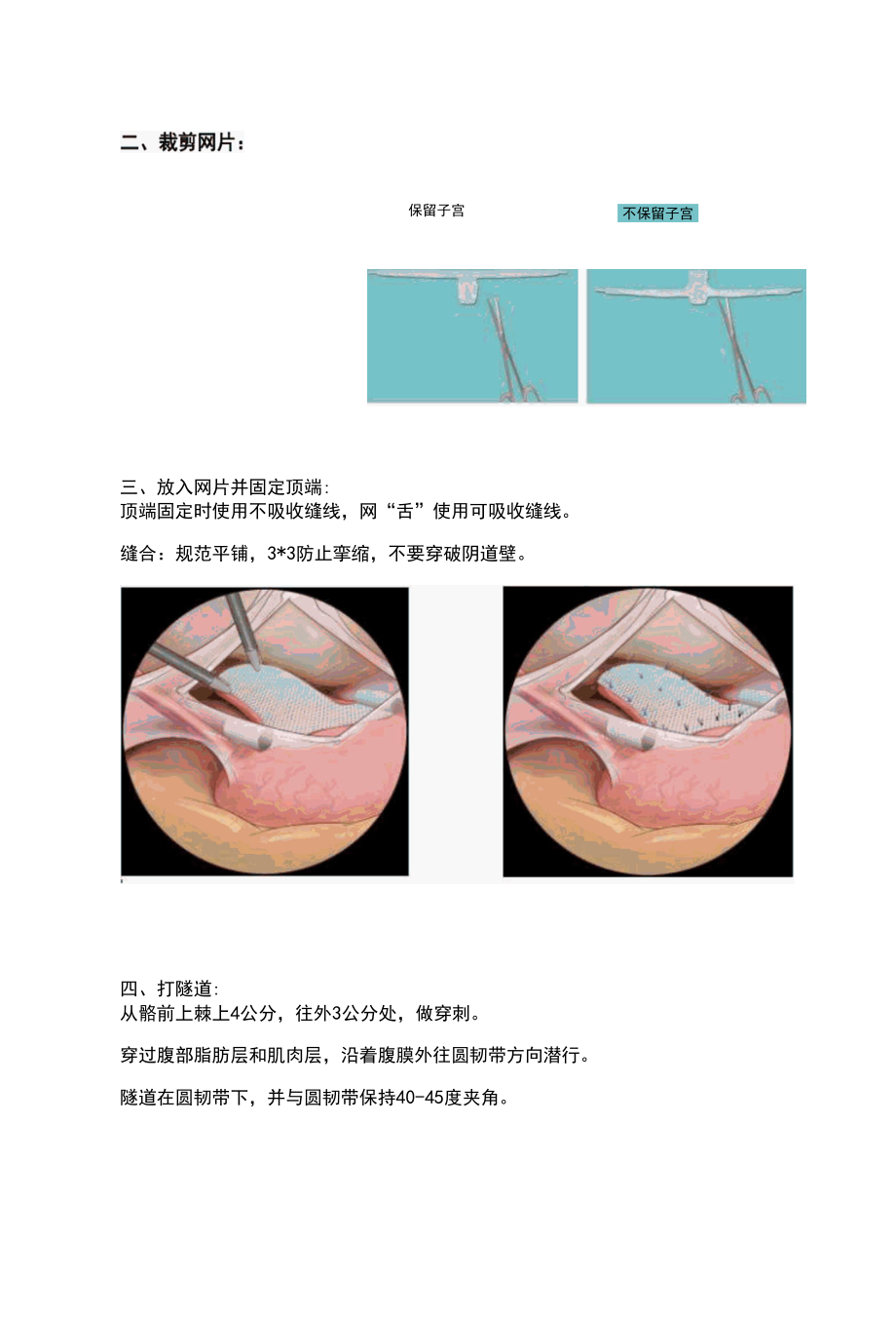 腹腔镜下侧腹壁悬吊术（LLS要点解析）.docx_第2页