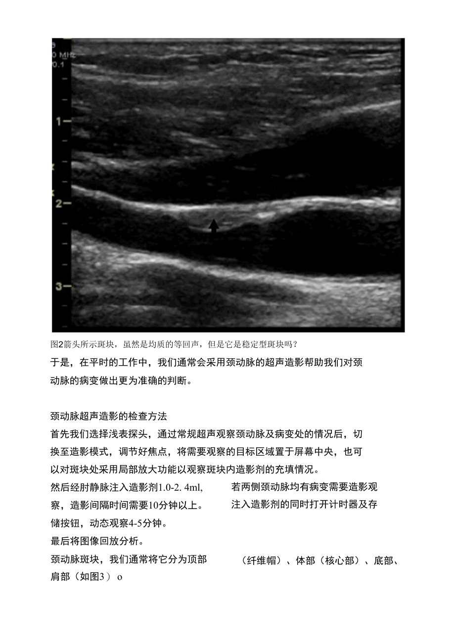 颈动脉斑块的超声造影识别.docx_第2页