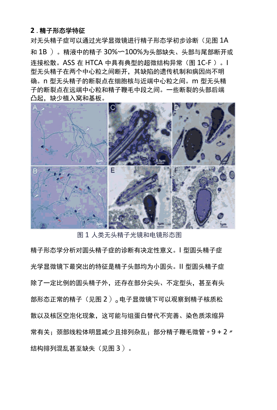 2022特殊类畸形精子症的诊疗全文.docx_第2页