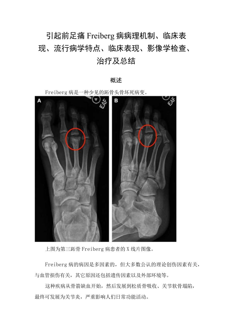 引起前足痛Freiberg病病理机制临床表现流行病学特点临床表现影像学检查治疗及总结.docx_第1页