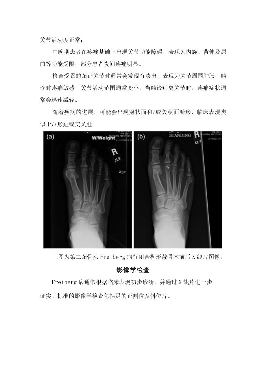 引起前足痛Freiberg病病理机制临床表现流行病学特点临床表现影像学检查治疗及总结.docx_第3页