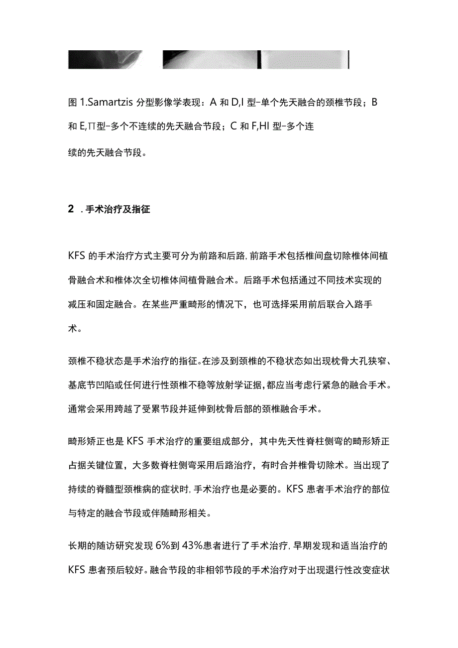 最新：KlippelFeil综合征影像学分型指导对手术治疗的研究进展（全文）.docx_第2页