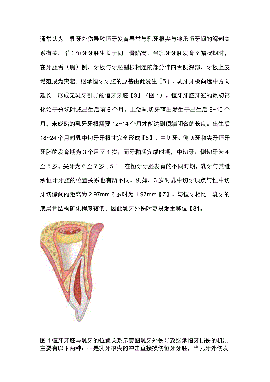 最新：乳牙外伤致恒牙发育异常的诊疗策略.docx_第2页