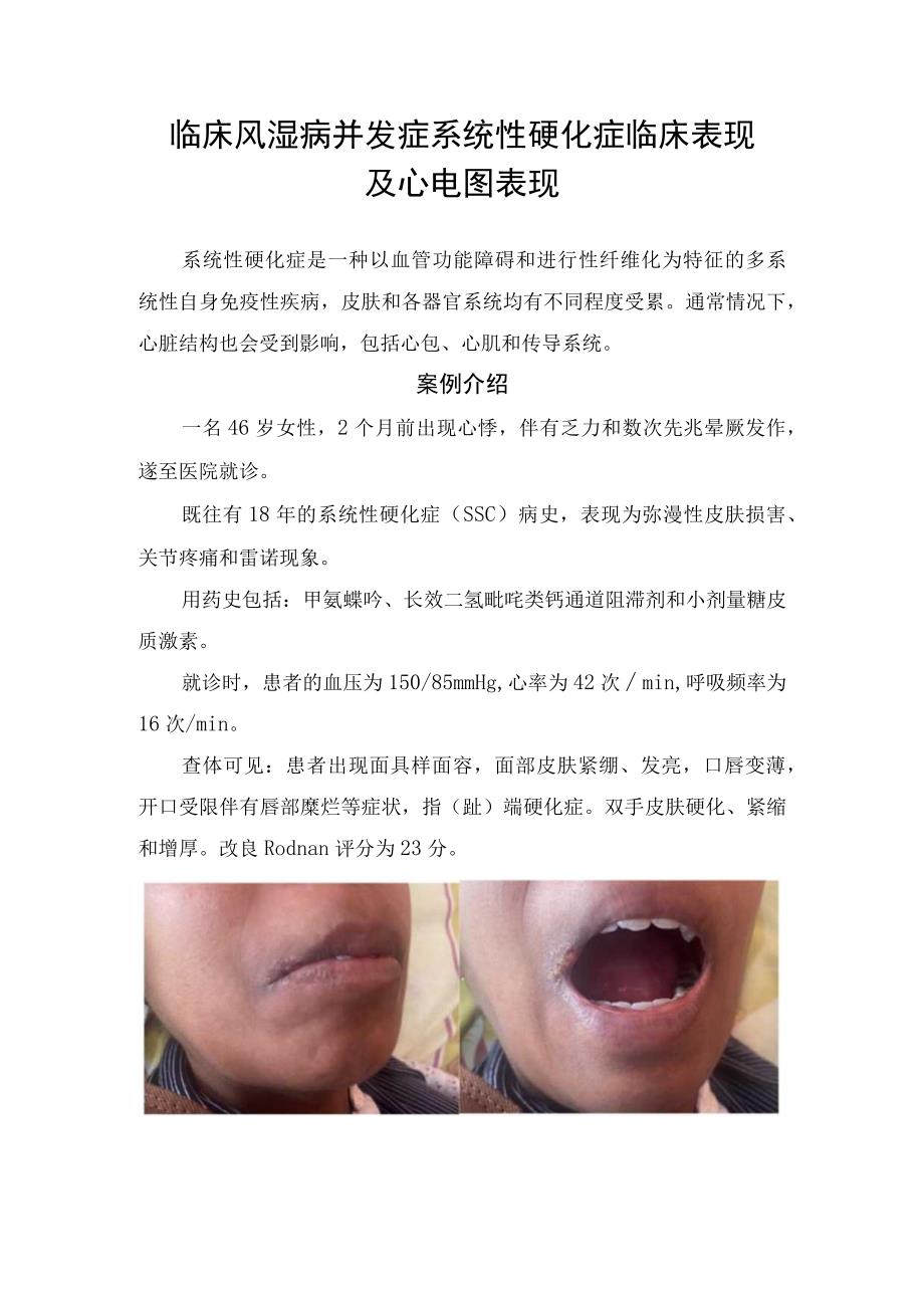 临床风湿病并发症系统性硬化症临床表现及心电图表现.docx_第1页