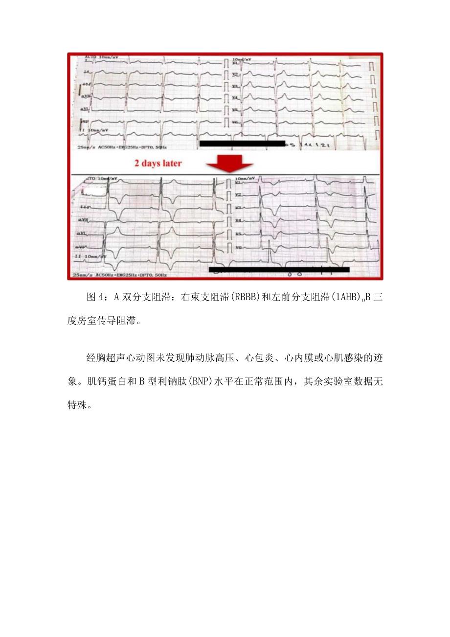 临床风湿病并发症系统性硬化症临床表现及心电图表现.docx_第3页