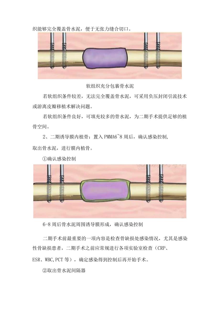 临床骨缺损修复术Masquelet 技术分期具体操作流程骨缺损愈合及负重及并发症.docx_第3页