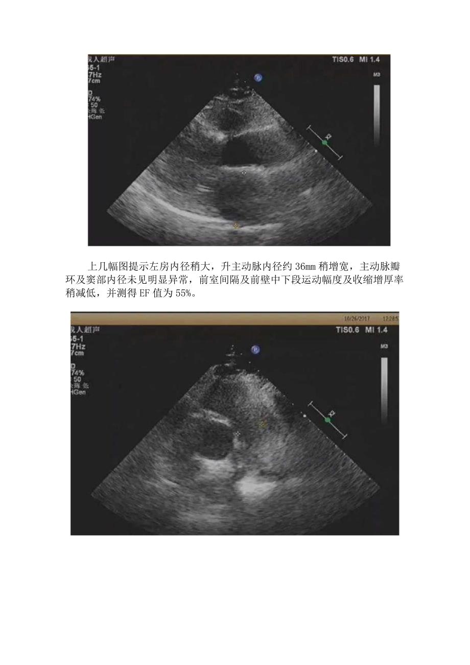 临床主动脉夹层动脉瘤病例分享影像学超声表现征象主动脉夹层分型及注意要点.docx_第2页