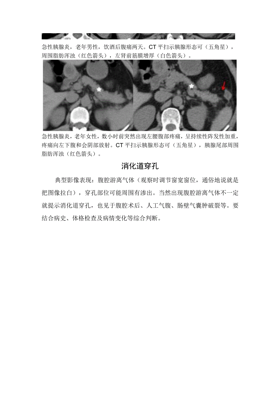 临床消化道穿孔肠梗阻急性胆囊炎急性胰腺炎尿路结石急性阑尾炎等急腹症影像学CT诊断.docx_第2页