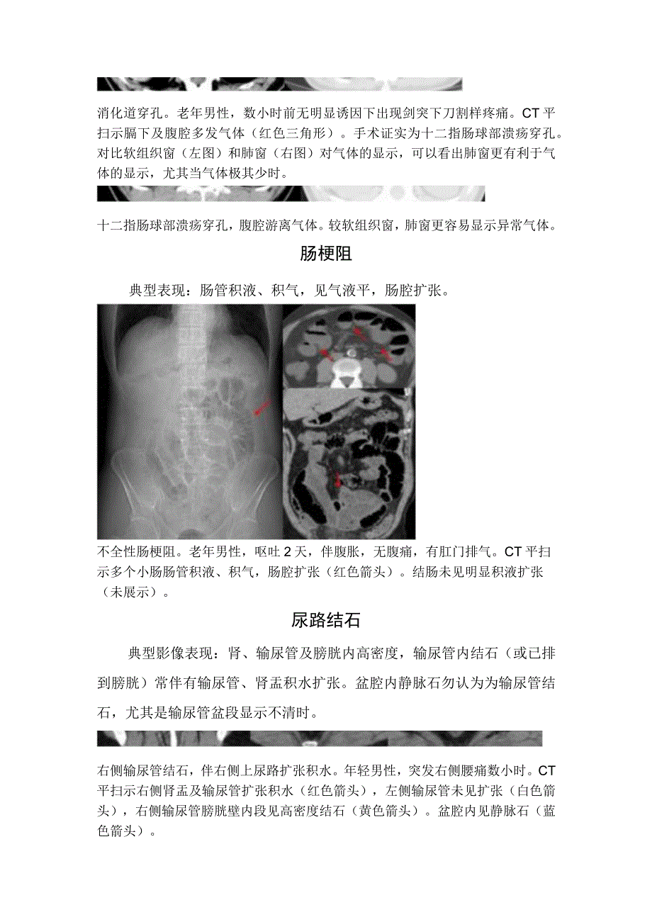 临床消化道穿孔肠梗阻急性胆囊炎急性胰腺炎尿路结石急性阑尾炎等急腹症影像学CT诊断.docx_第3页