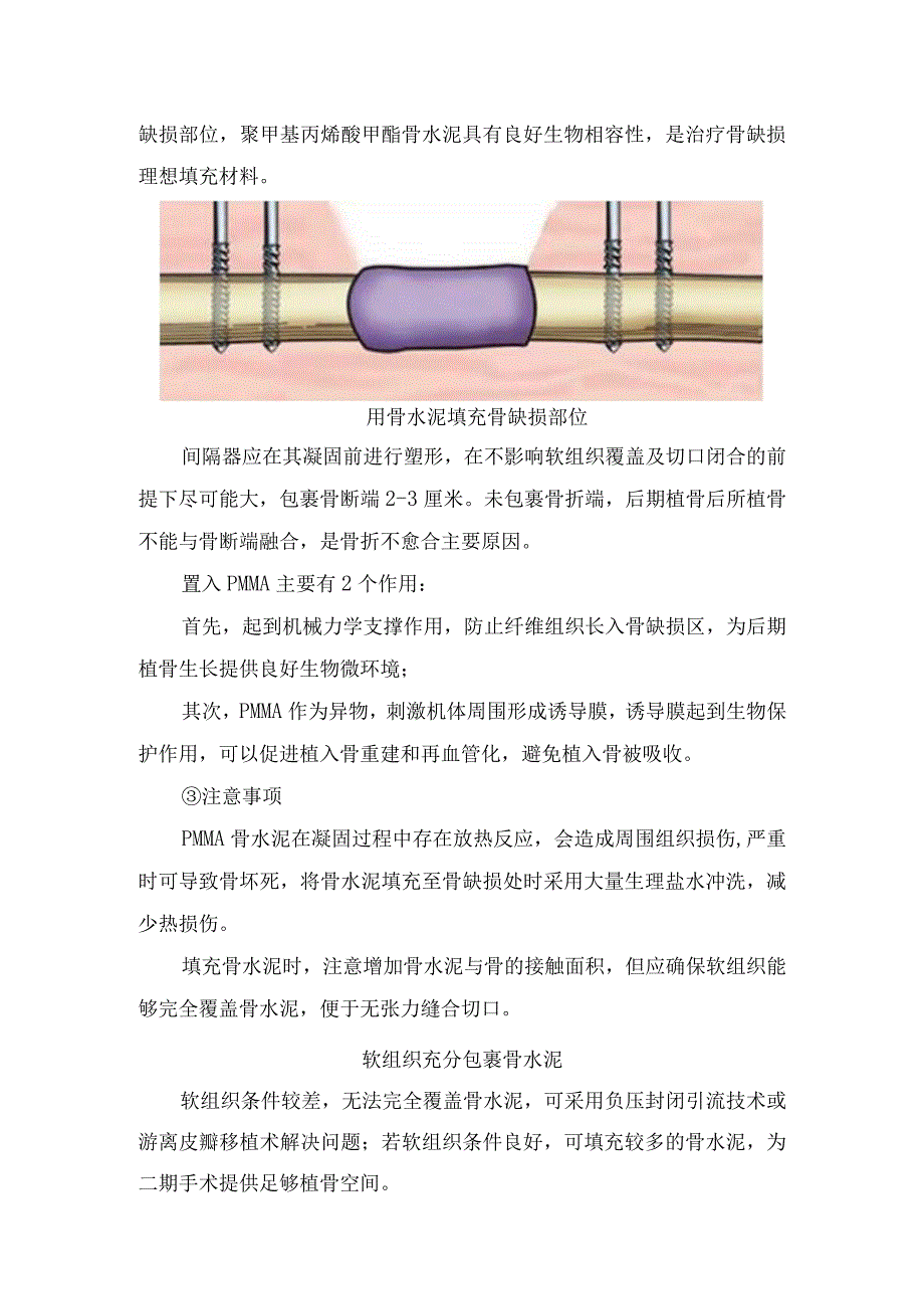 临床骨缺损修复术Masquelet技术分期具体操作流程骨缺损愈合及负重及并发症.docx_第2页