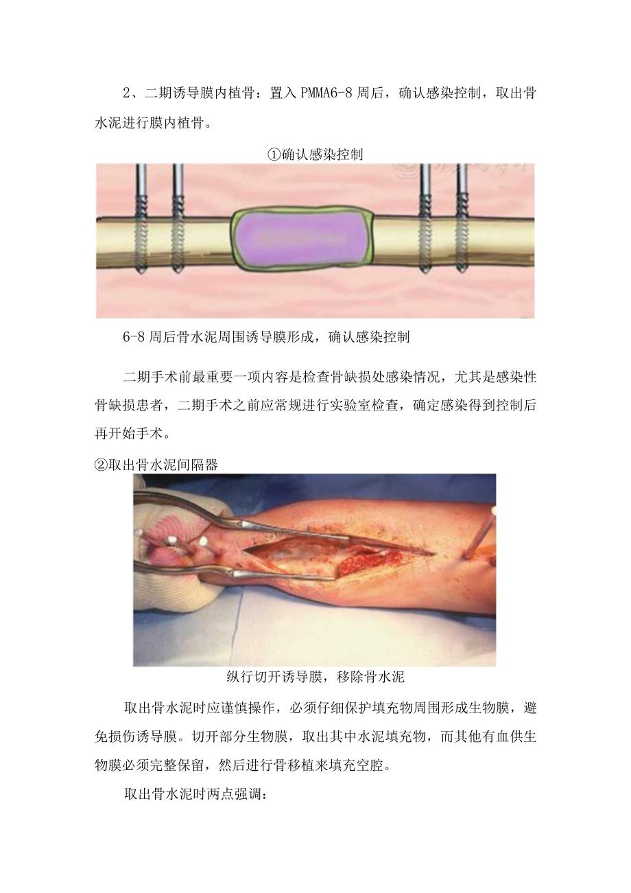 临床骨缺损修复术Masquelet技术分期具体操作流程骨缺损愈合及负重及并发症.docx_第3页