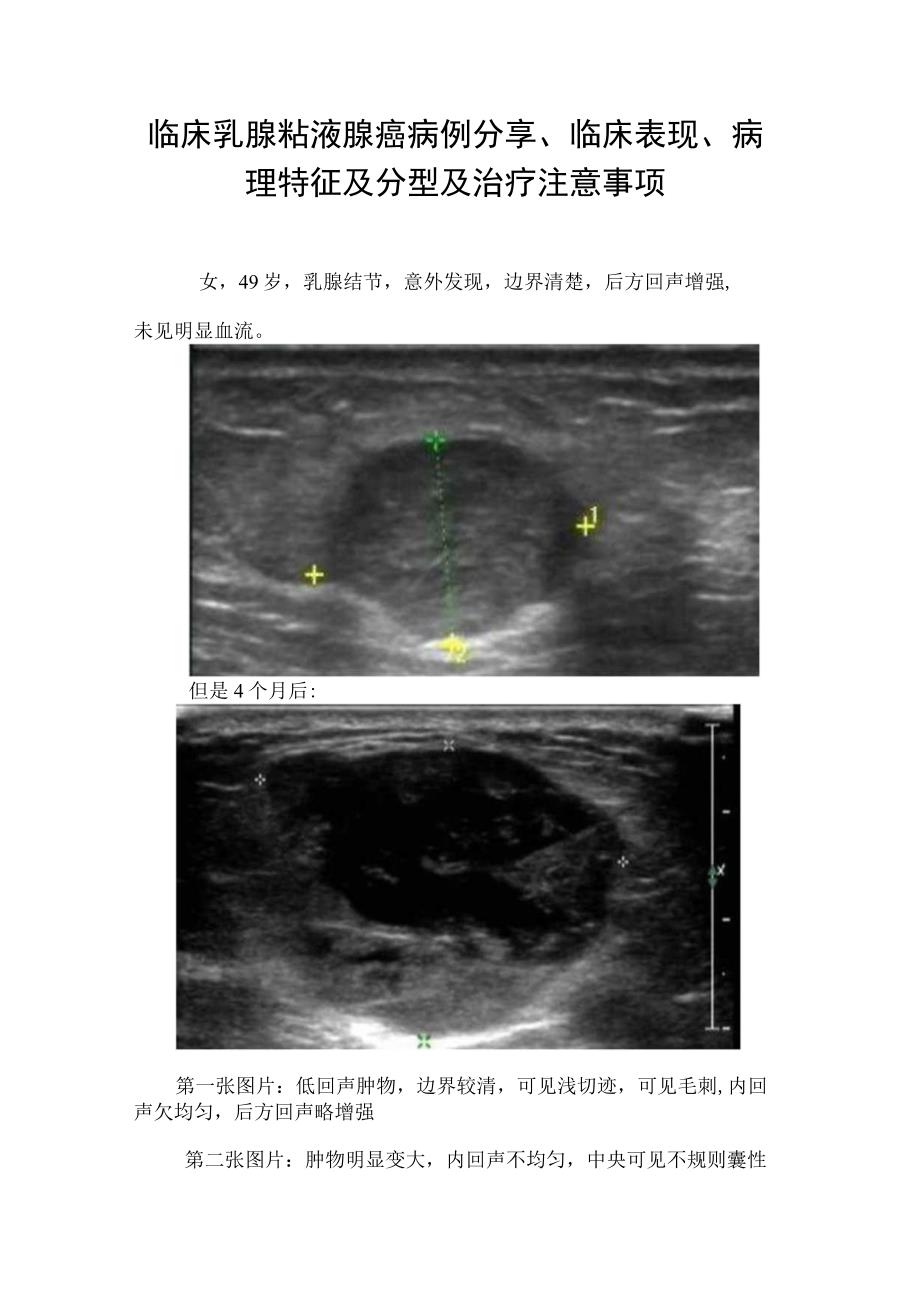 临床乳腺粘液腺癌病例分享临床表现病理特征及分型及治疗注意事项.docx_第1页