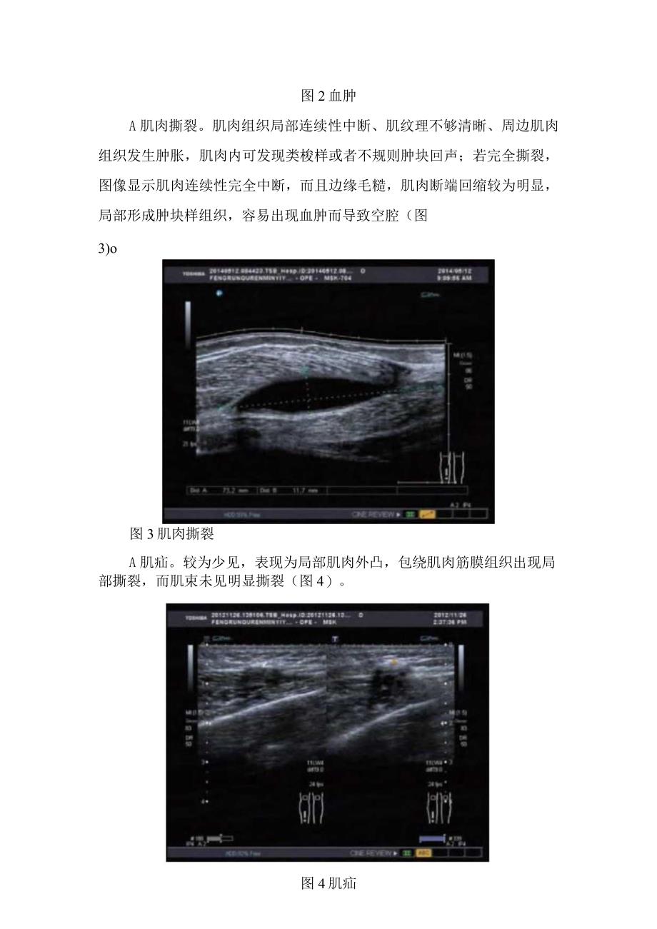 临床肌肉损伤疾病病理机制超声检查方法及肌肉挫伤血肿肌肉撕裂和肌疝等肌肉损伤影像学判断.docx_第3页