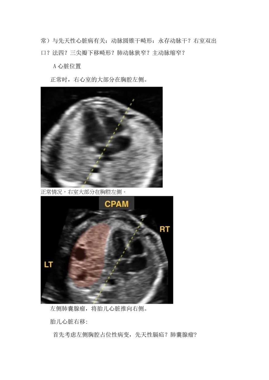 临床胎儿心脏轴向异常和位置异常.docx_第2页