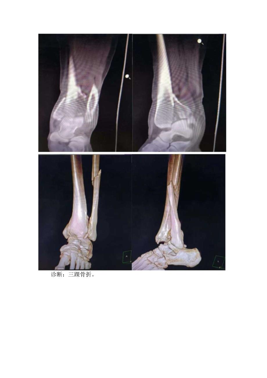 三踝骨折诊断处理及影像学表现.docx_第2页