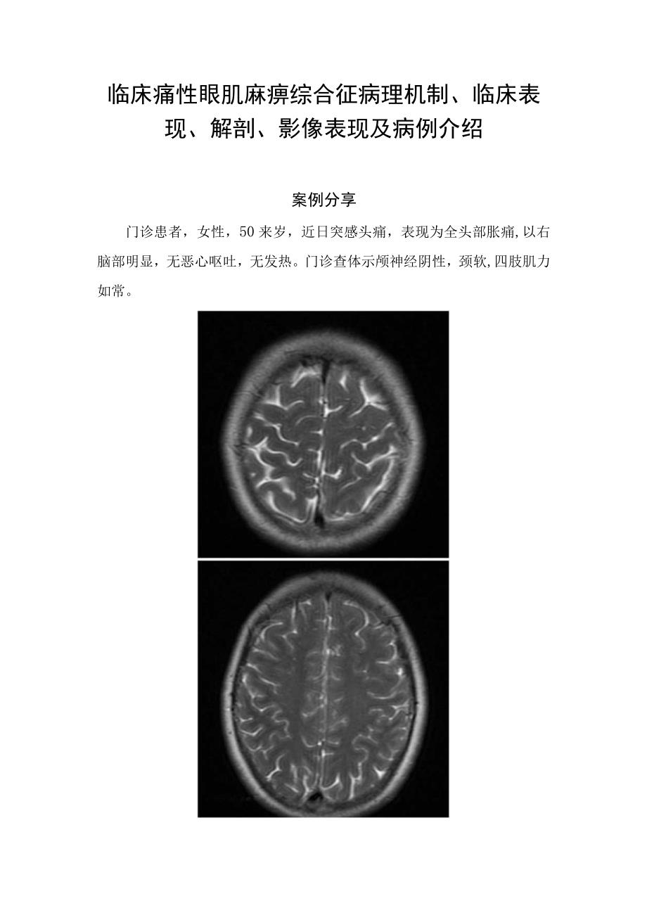 临床痛性眼肌麻痹综合征病理机制临床表现解剖影像表现及病例介绍(1).docx_第1页