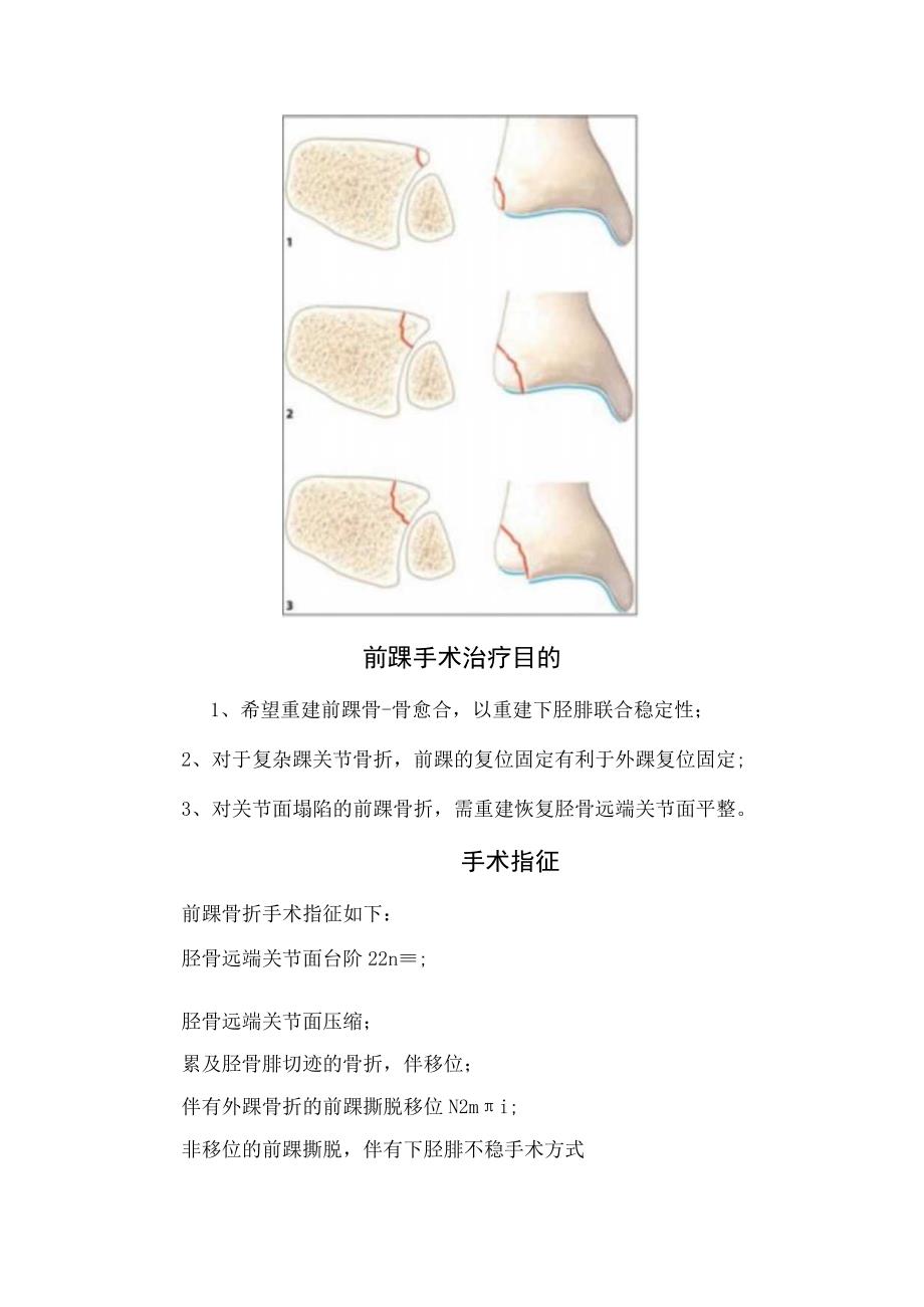 临床前踝骨折损伤机制骨折分类前踝手术治疗目的及手术指征.docx_第2页