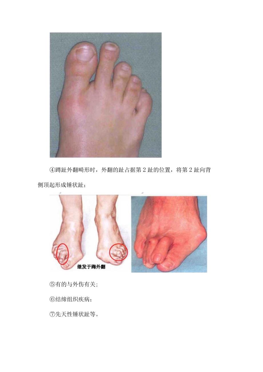 临床锤状趾疾病发生机制高发年龄临床表现与评估及治疗措施技巧.docx_第3页