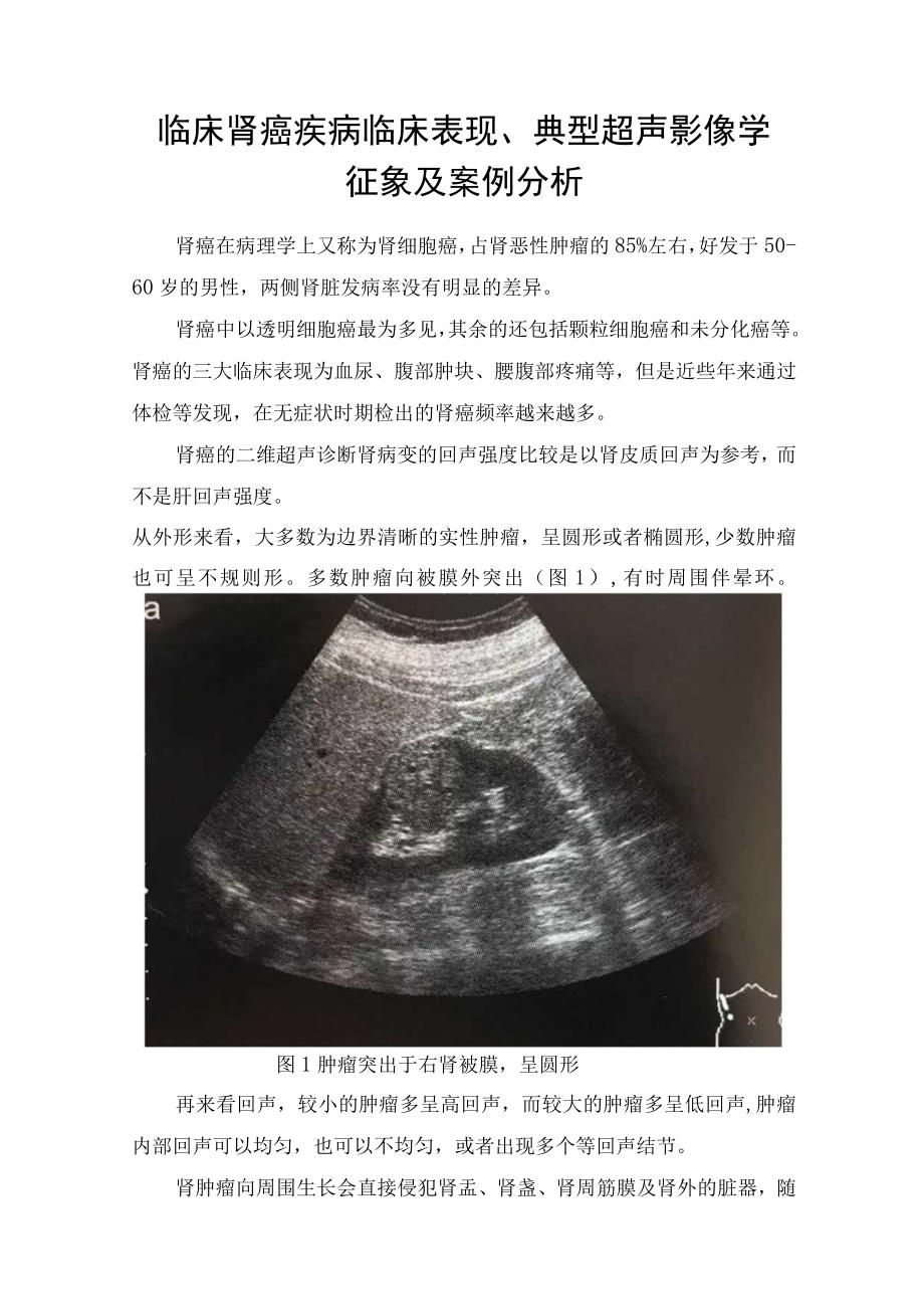 临床肾癌疾病临床表现典型超声影像学征象及案例分析.docx_第1页