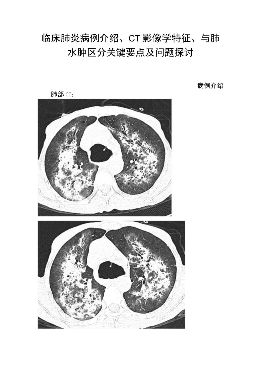 临床肺炎病例介绍CT影像学特征与肺水肿区分关键要点及问题探讨.docx_第1页