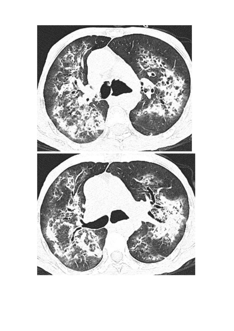 临床肺炎病例介绍CT影像学特征与肺水肿区分关键要点及问题探讨.docx_第2页