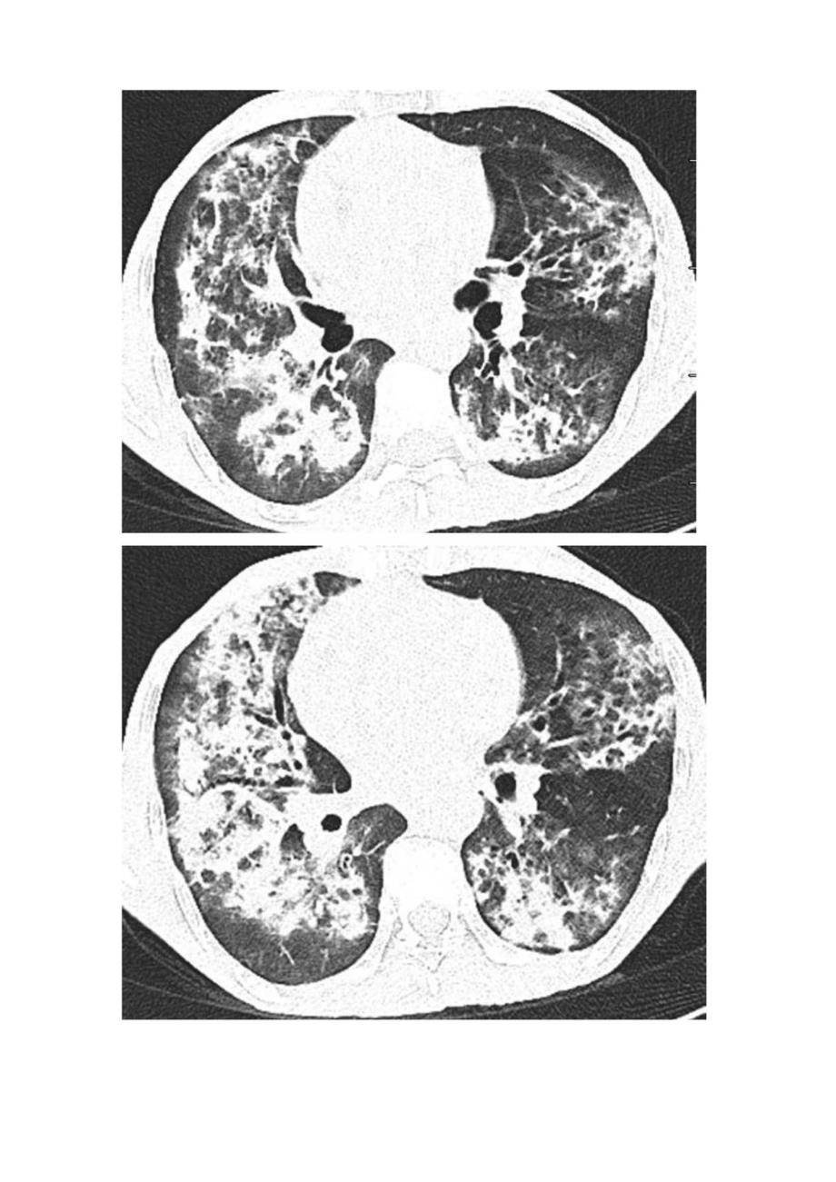 临床肺炎病例介绍CT影像学特征与肺水肿区分关键要点及问题探讨.docx_第3页
