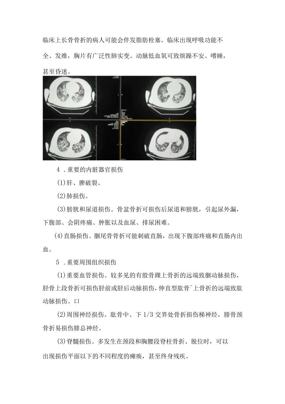 休克脂肪栓塞综合征内脏器损伤坠积性肺炎压疮等常见骨折后早晚期并发症预防发生康复治疗注意事项.docx_第2页