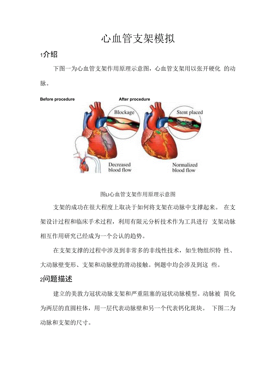 CAE心血管支架模拟.docx_第1页