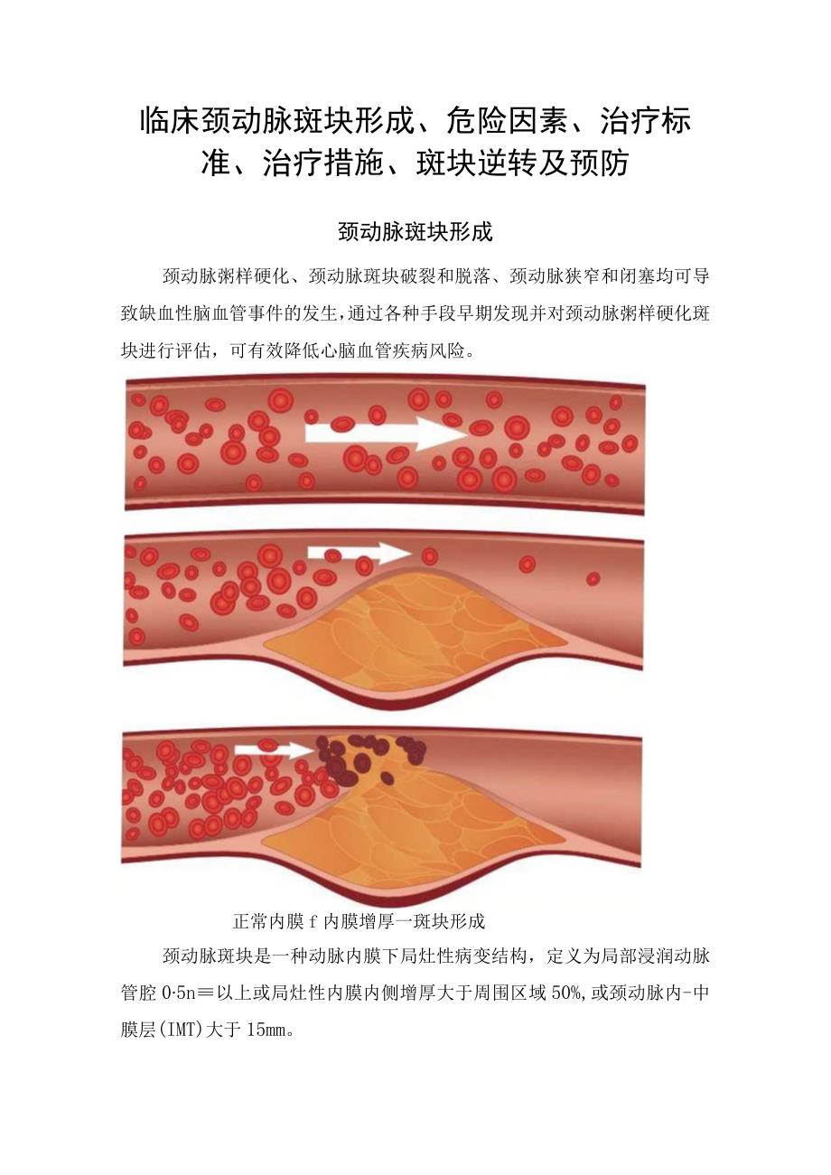 临床颈动脉斑块形成危险因素治疗标准治疗措施斑块逆转及预防.docx_第1页