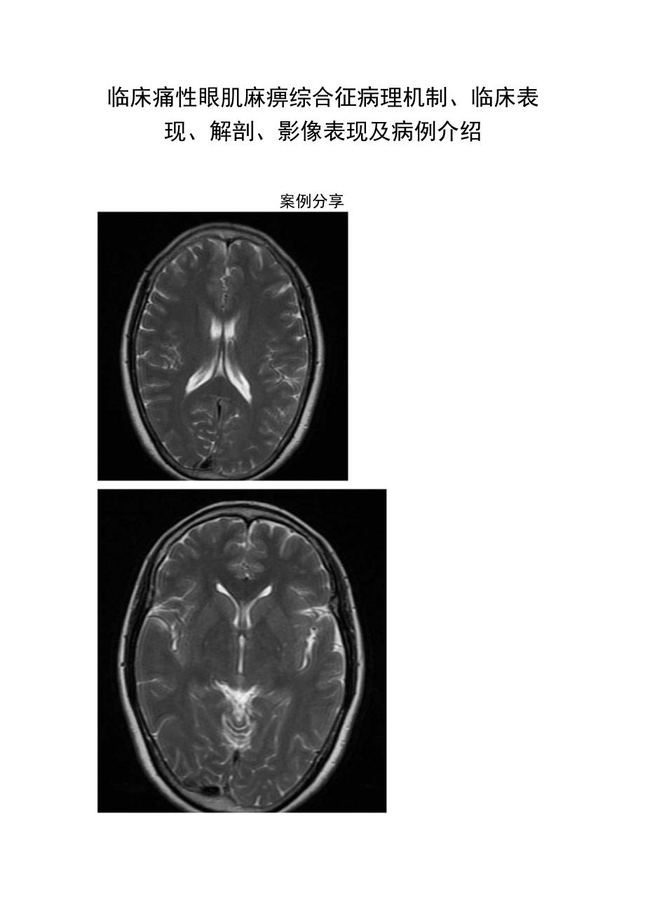 临床痛性眼肌麻痹综合征病理机制临床表现解剖影像表现及病例介绍.docx_第1页