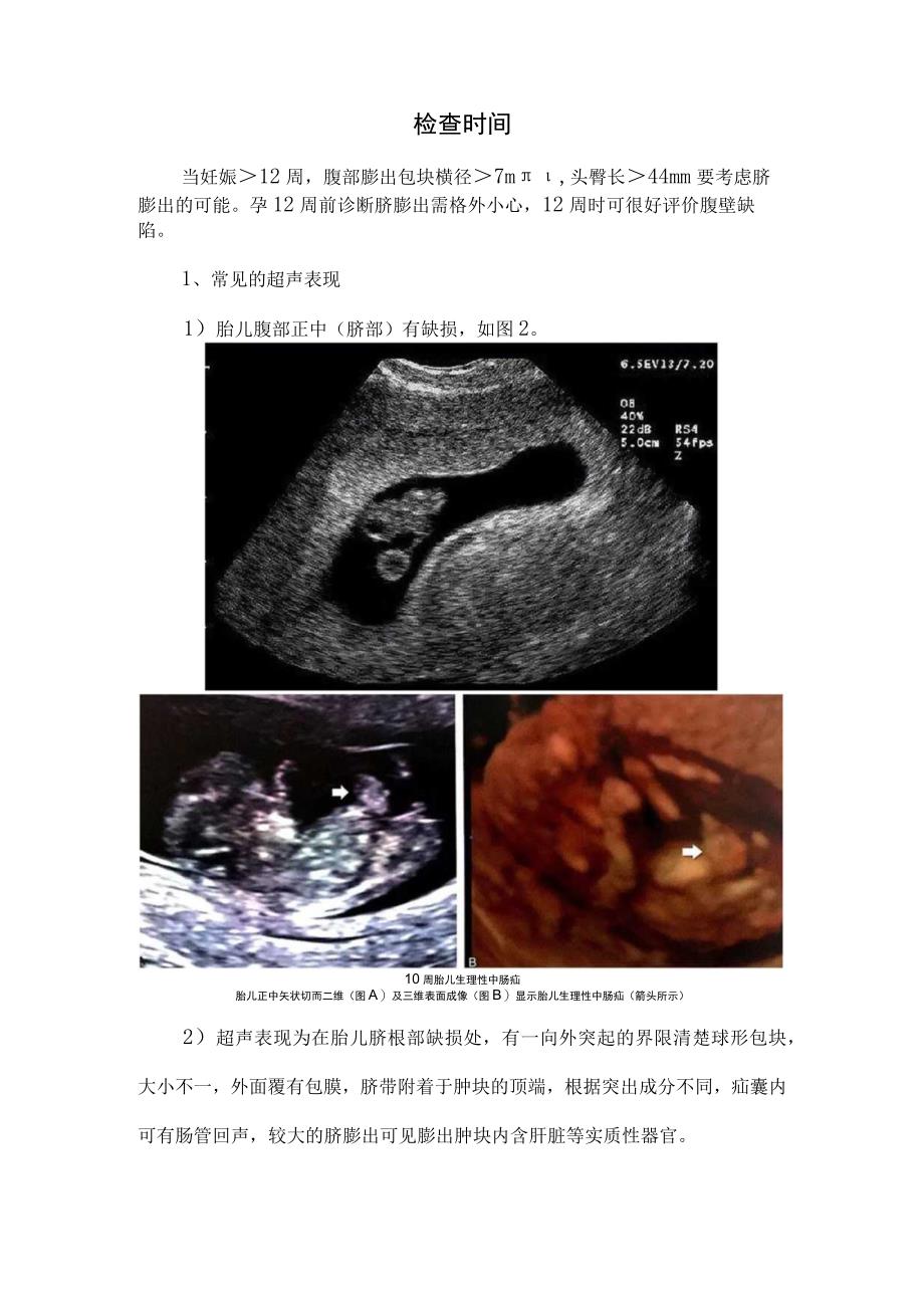 临床脐膨出超声诊断生理性肠疝区别鉴别诊断注意事项及预后.docx_第2页