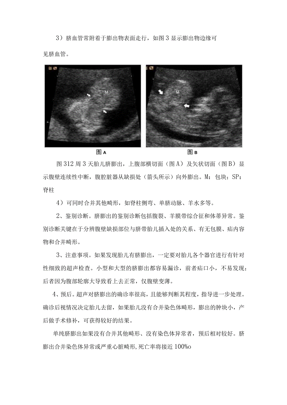 临床脐膨出超声诊断生理性肠疝区别鉴别诊断注意事项及预后.docx_第3页