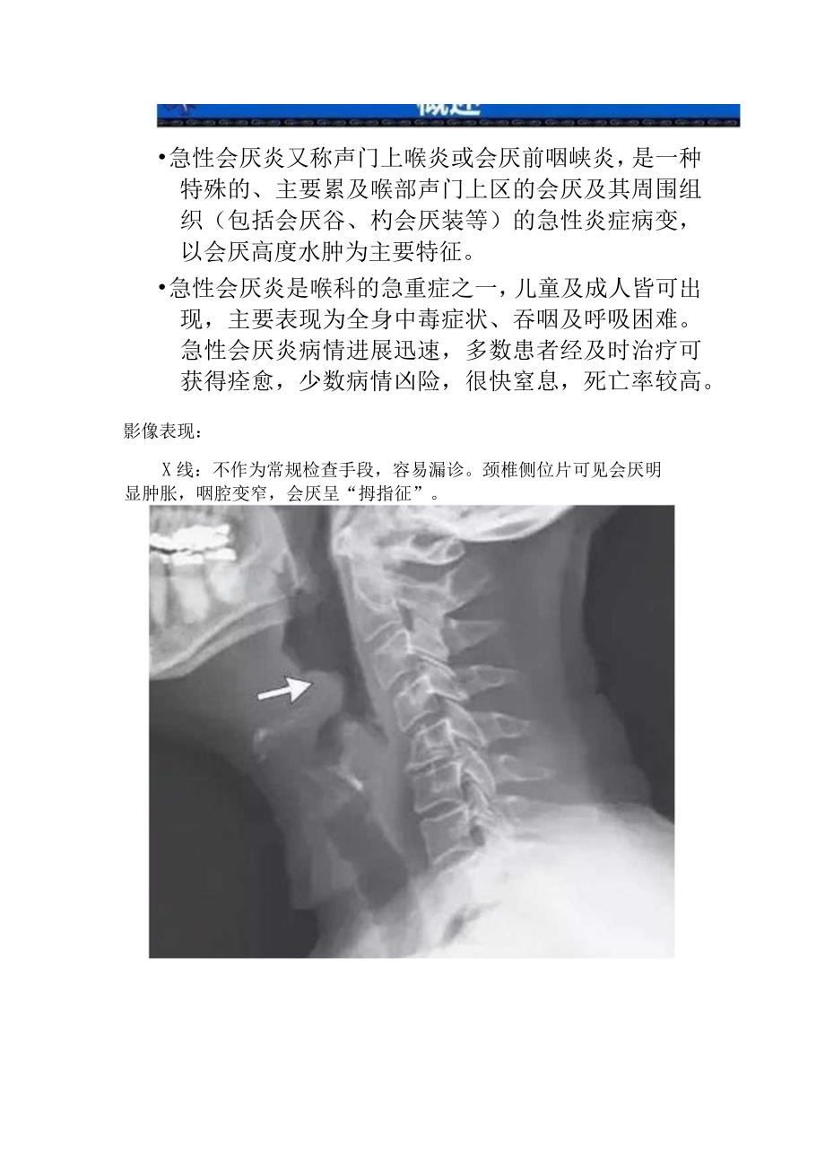 临床急性会厌炎拇指征征象解读解剖及CTX线MRI影像学表现特征.docx_第2页