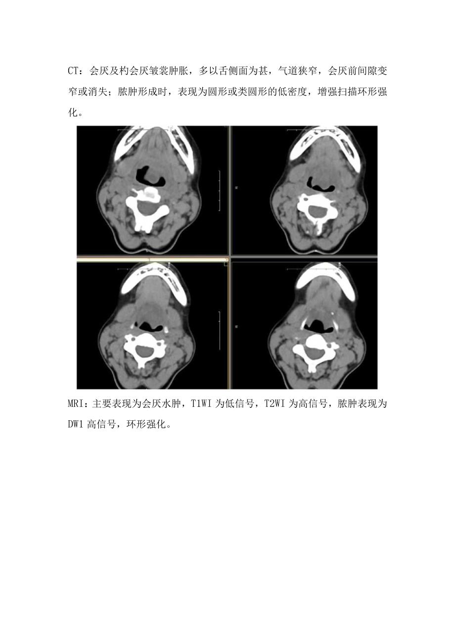 临床急性会厌炎拇指征征象解读解剖及CTX线MRI影像学表现特征.docx_第3页