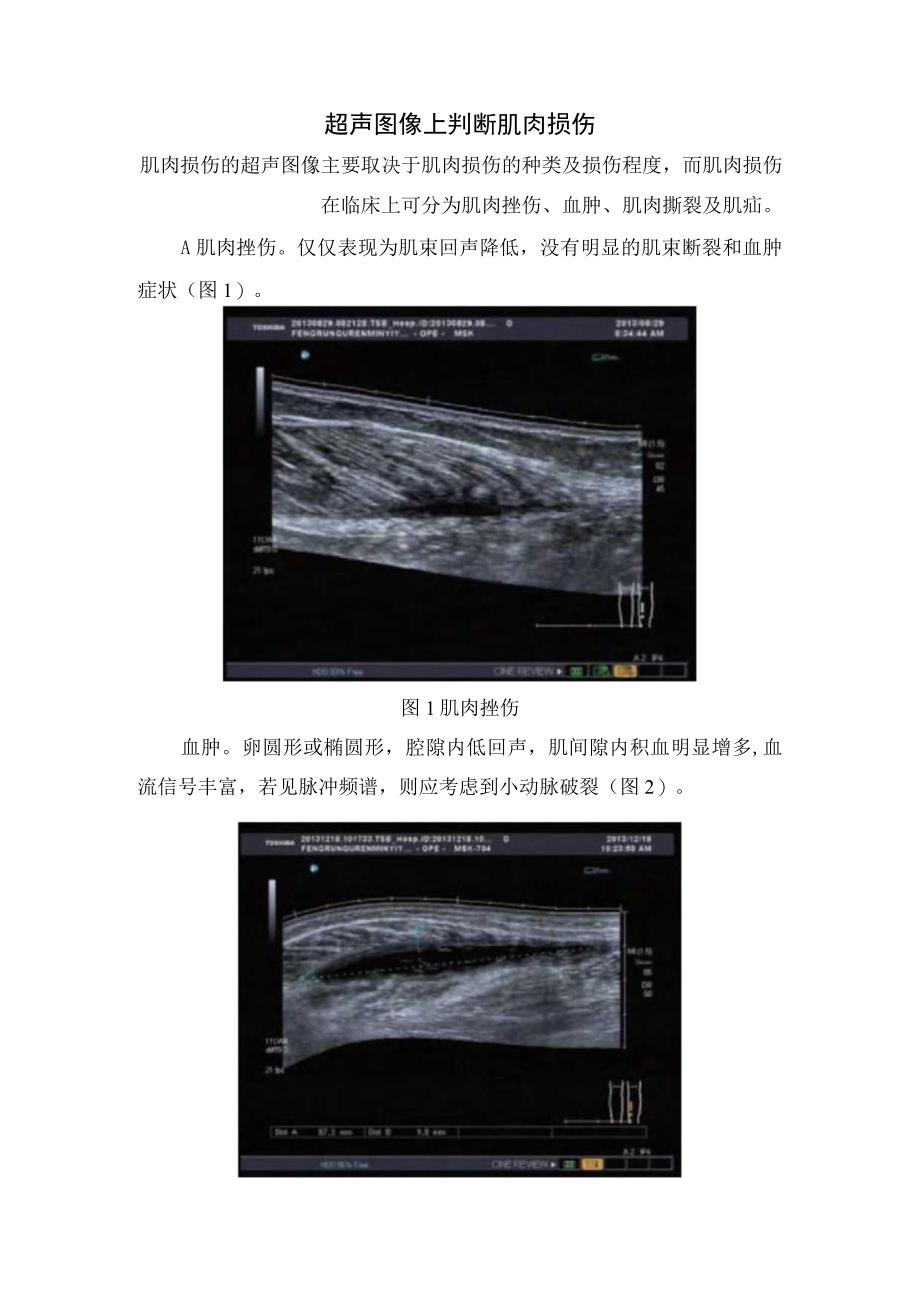 临床肌肉损伤疾病病理机制超声检查方法及肌肉挫伤血肿肌肉撕裂和肌疝等肌肉损伤影像学判断.docx_第2页