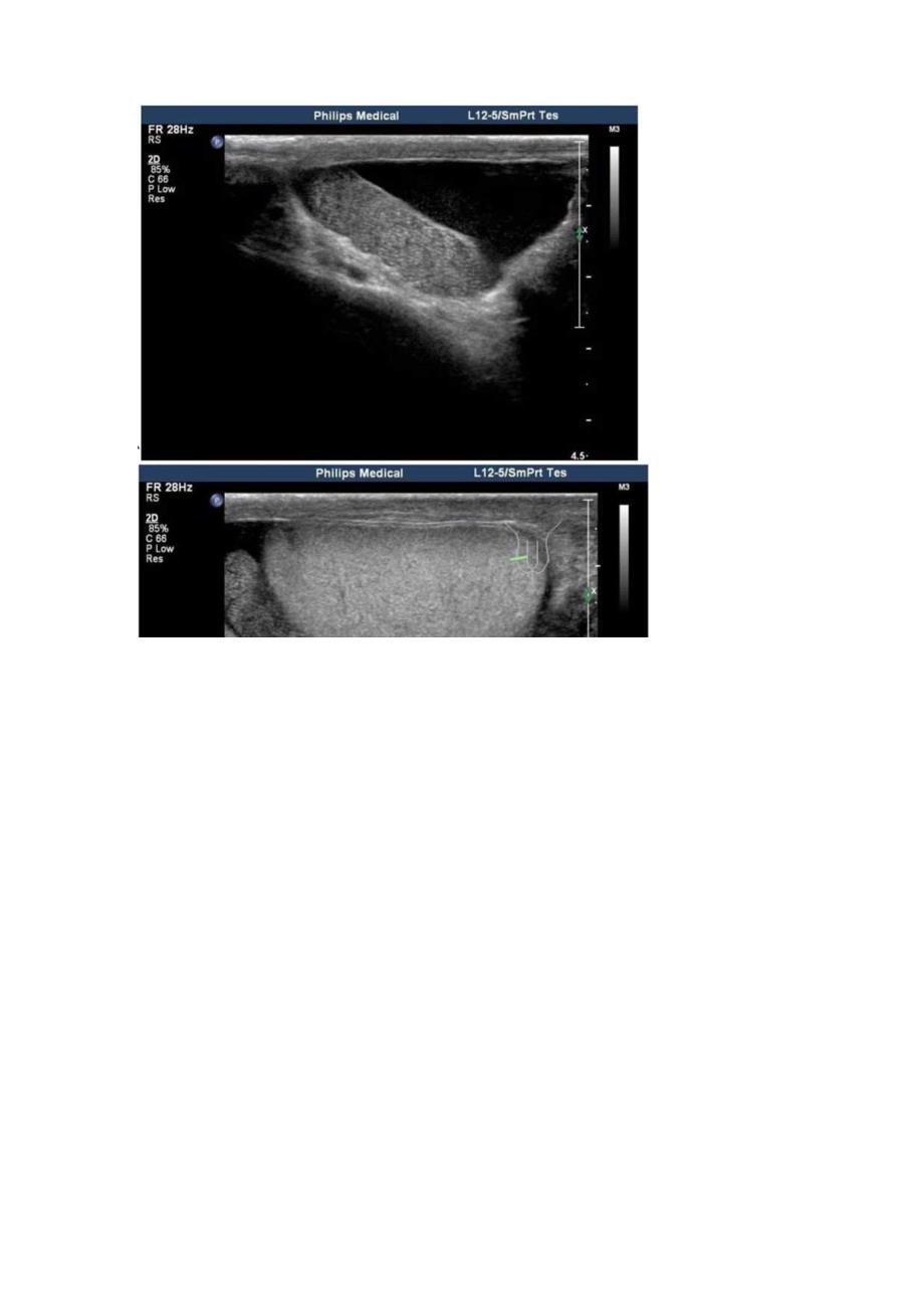 临床附睾淤积症超声表现影像学诊断及附睾结核和附睾炎鉴别诊断要点.docx_第2页