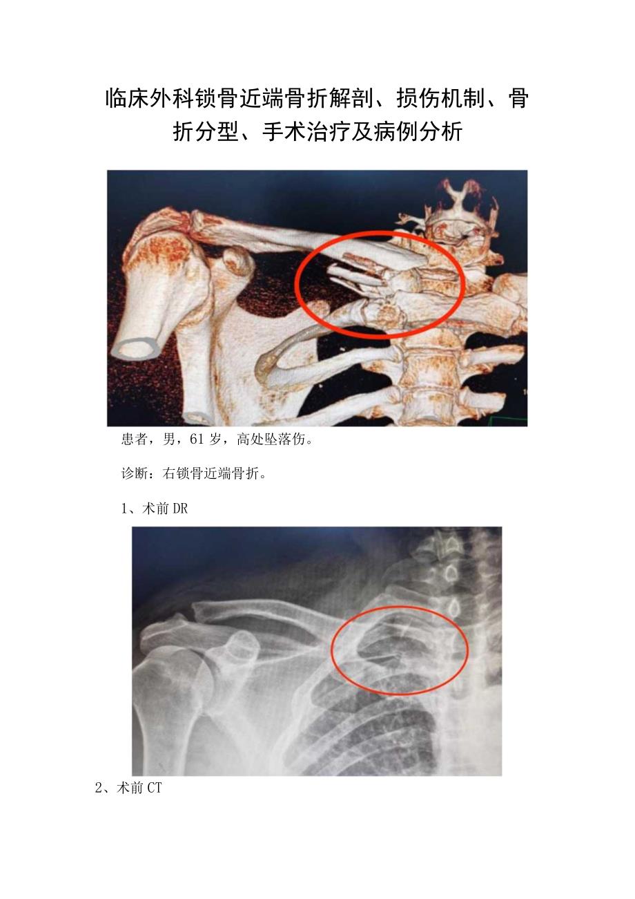 临床外科锁骨近端骨折解剖损伤机制骨折分型手术治疗及病例分析.docx_第1页