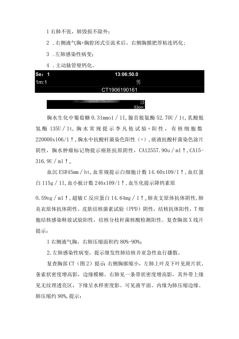 临床耐多药结核病疾病分享及发病机制及治疗措施.docx_第2页