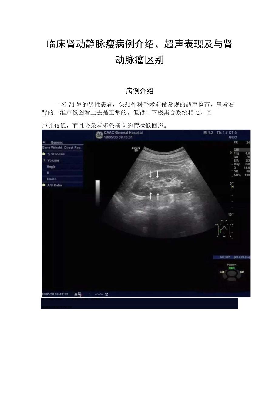 临床肾动静脉瘘病例介绍超声表现及与肾动脉瘤区别.docx_第1页