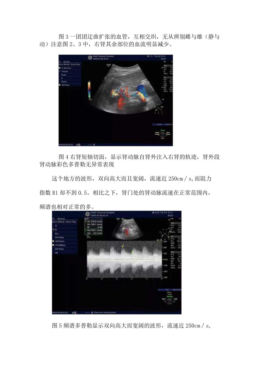 临床肾动静脉瘘病例介绍超声表现及与肾动脉瘤区别.docx_第3页