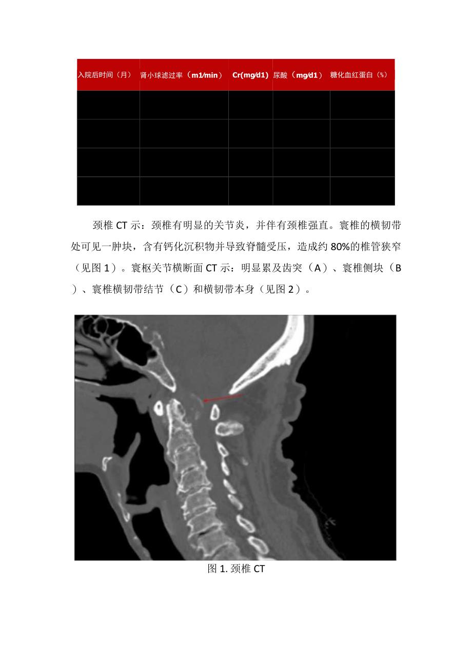 临床双手麻木感觉异常症状疾病颈椎疾病病例分享及案例分析.docx_第2页