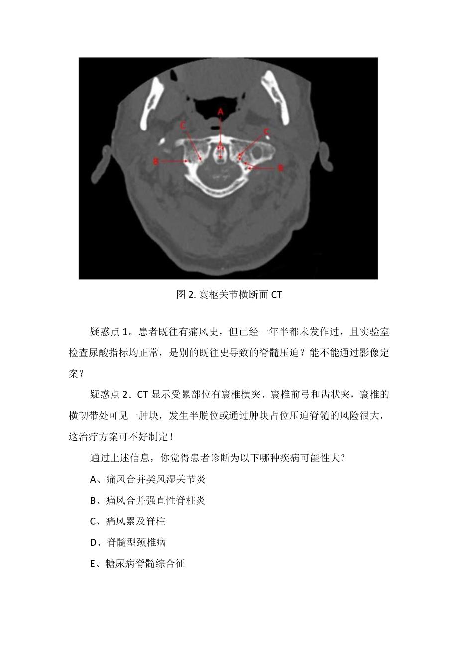 临床双手麻木感觉异常症状疾病颈椎疾病病例分享及案例分析.docx_第3页