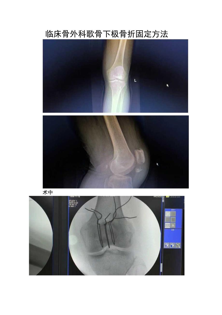 临床骨外科髌骨下极骨折固定方法.docx_第1页