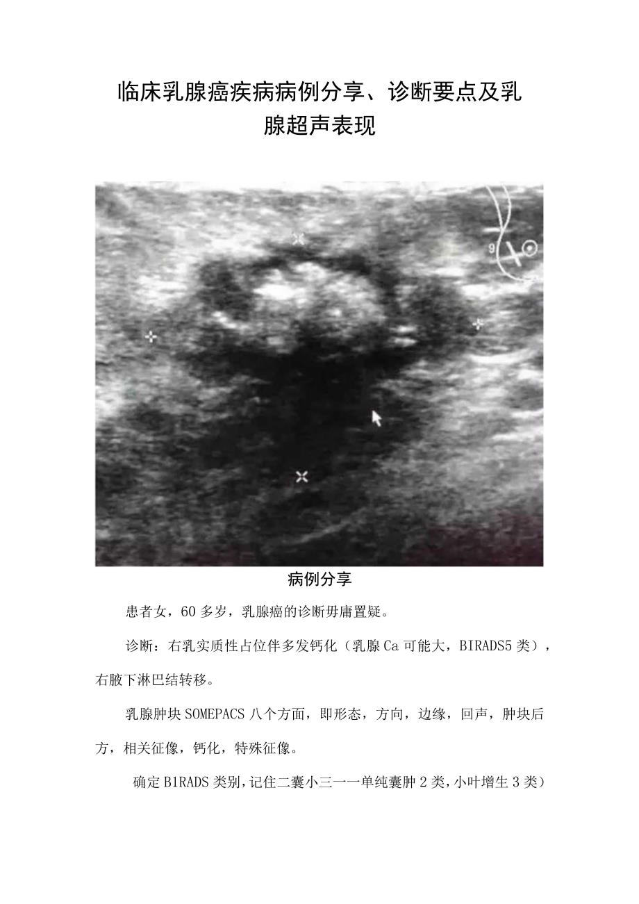 临床乳腺癌疾病病例分享诊断要点及乳腺超声表现.docx_第1页