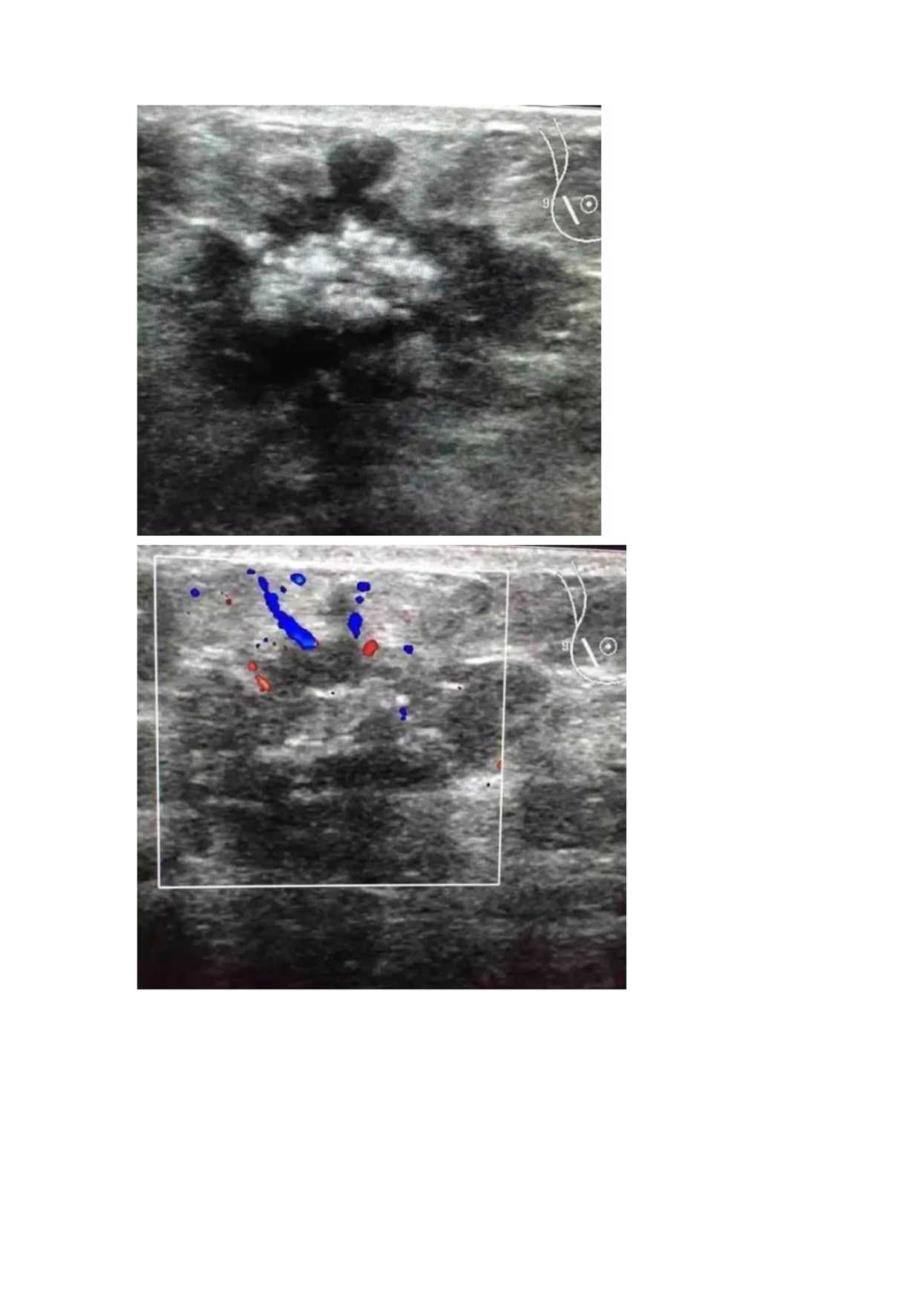 临床乳腺癌疾病病例分享诊断要点及乳腺超声表现.docx_第3页