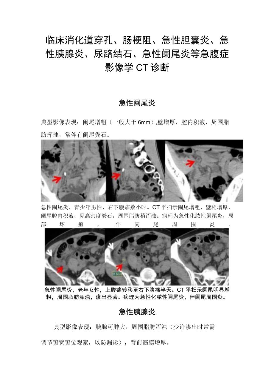 临床消化道穿孔肠梗阻急性胆囊炎急性胰腺炎尿路结石急性阑尾炎等急腹症影像学CT诊断.docx_第1页