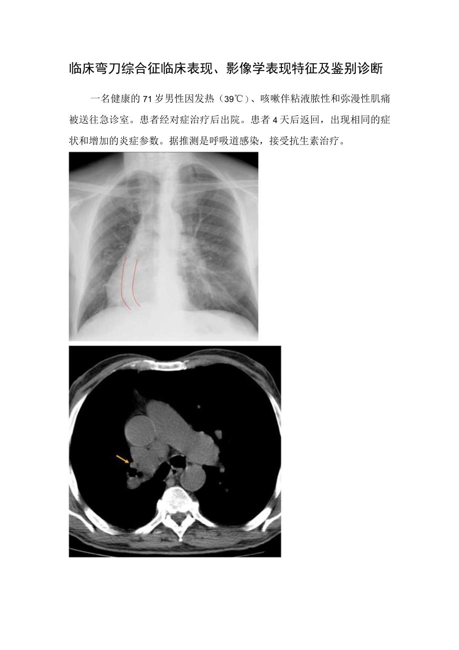 临床弯刀综合征临床表现影像学表现特征及鉴别诊断.docx_第1页