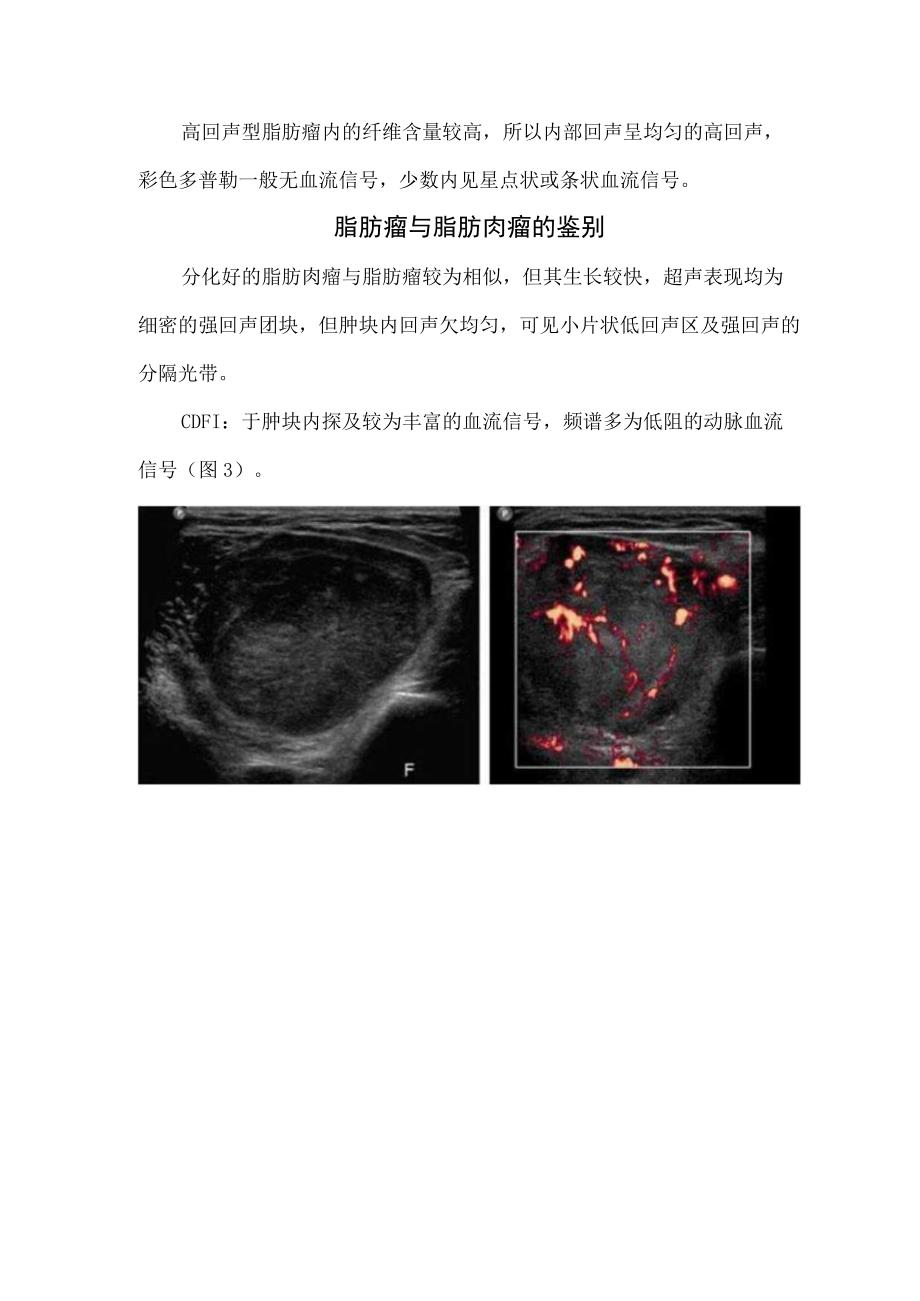 脂肪瘤疾病发病机制高发年龄常见部位超声表现及与脂肪肉瘤鉴别诊断.docx_第3页